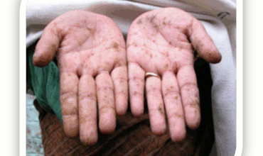 Contaminação Arsenio