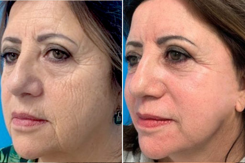Peeling de fenol